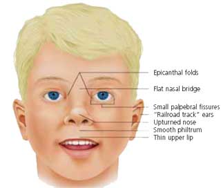 down-syndrome-facial-defects